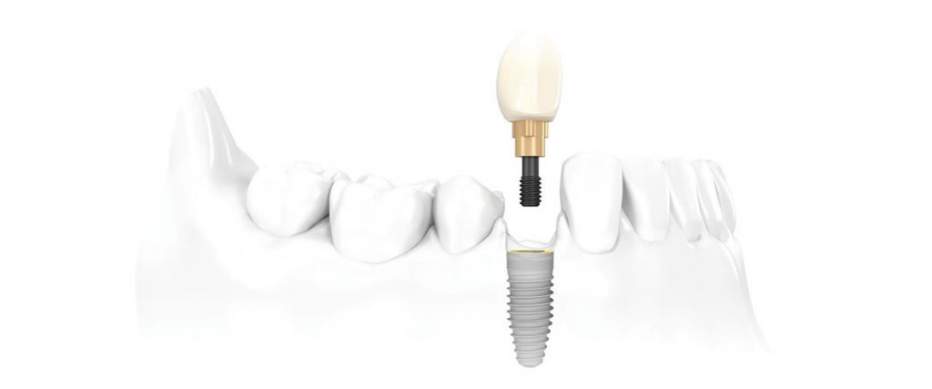 impianti dentali titanio osteointegrazione