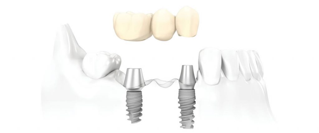 impianto dentale con corona ceramica