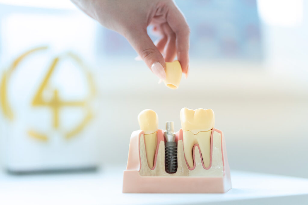 Impianto dentale Orto Nova