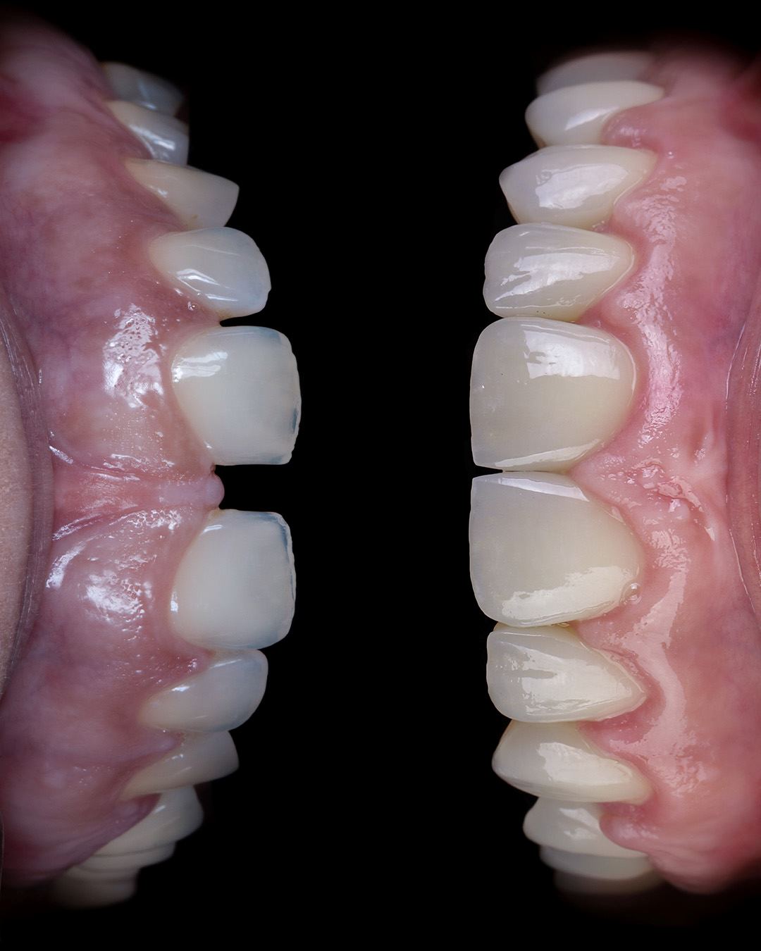 medicina estetica dentale prima e dopo