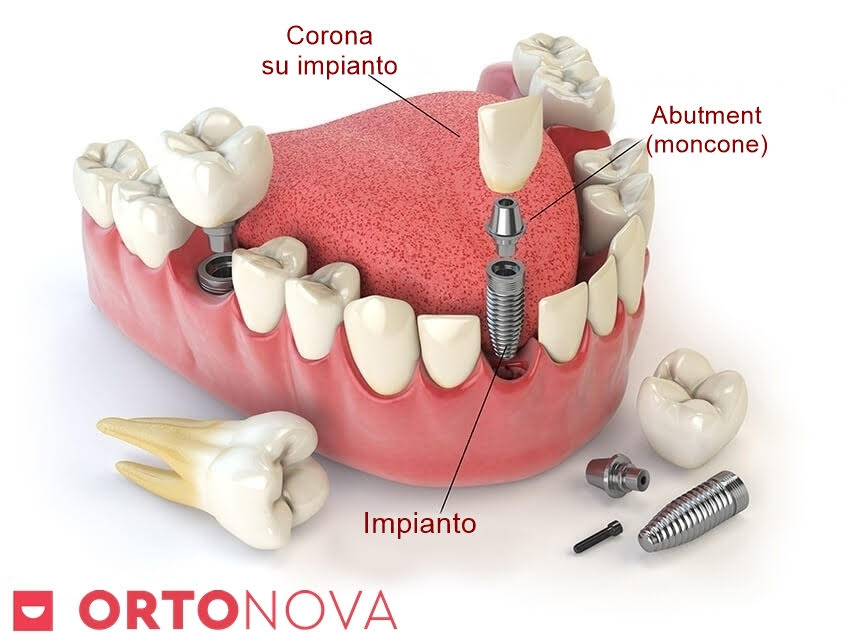 impianto dentale Orto Nova